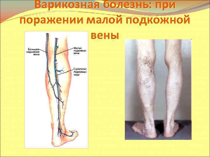 Варикозная болезнь: при поражении малой подкожной вены 