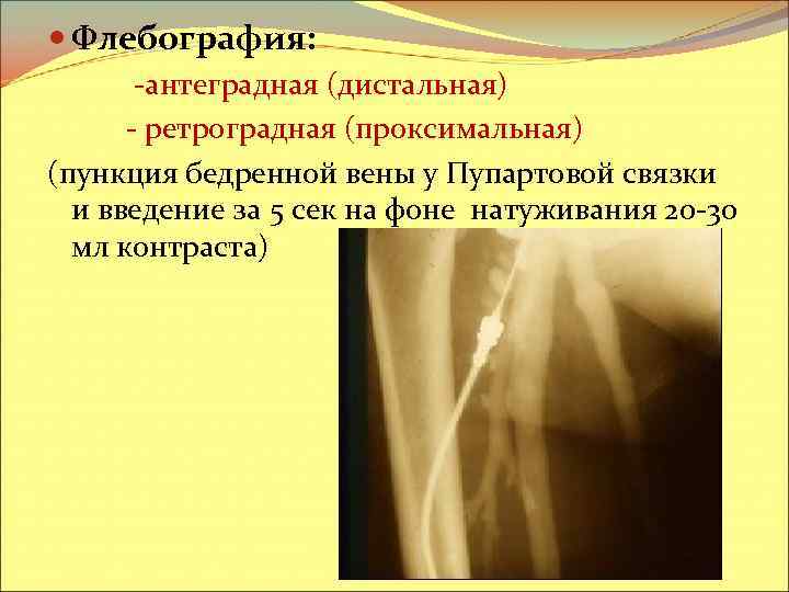  Флебография: -антеградная (дистальная) - ретроградная (проксимальная) (пункция бедренной вены у Пупартовой связки и