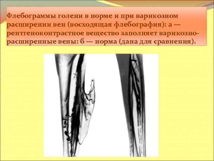 Флебограммы голени в норме и при варикозном расширении вен (восходящая флебография): а — рентгеноконтрастное