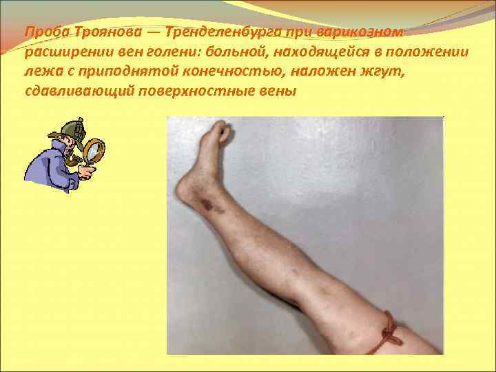 Проба Троянова — Тренделенбурга при варикозном расширении вен голени: больной, находящейся в положении лежа