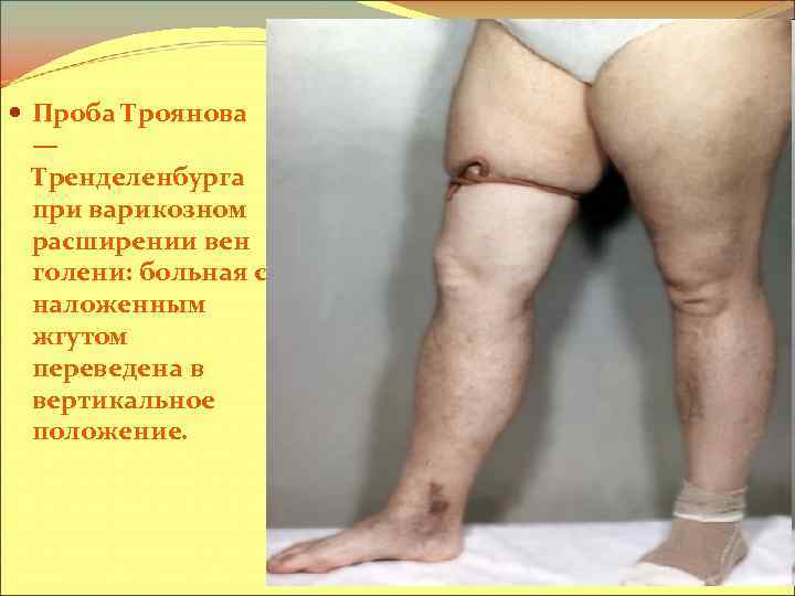  Проба Троянова — Тренделенбурга при варикозном расширении вен голени: больная с наложенным жгутом