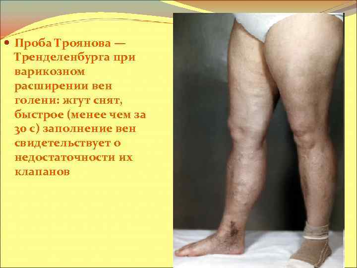  Проба Троянова — Тренделенбурга при варикозном расширении вен голени: жгут снят, быстрое (менее