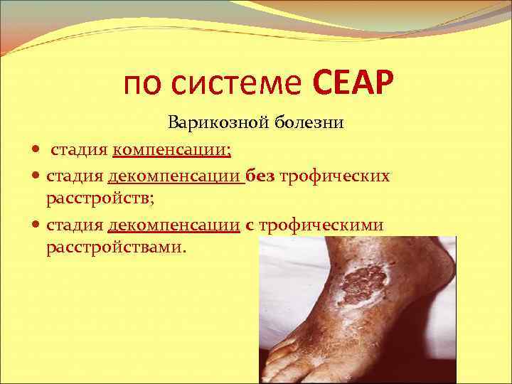 по системе CEAP Варикозной болезни стадия компенсации; стадия декомпенсации без трофических расстройств; стадия декомпенсации