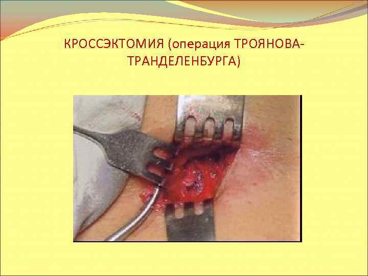 КРОССЭКТОМИЯ (операция ТРОЯНОВАТРАНДЕЛЕНБУРГА) 