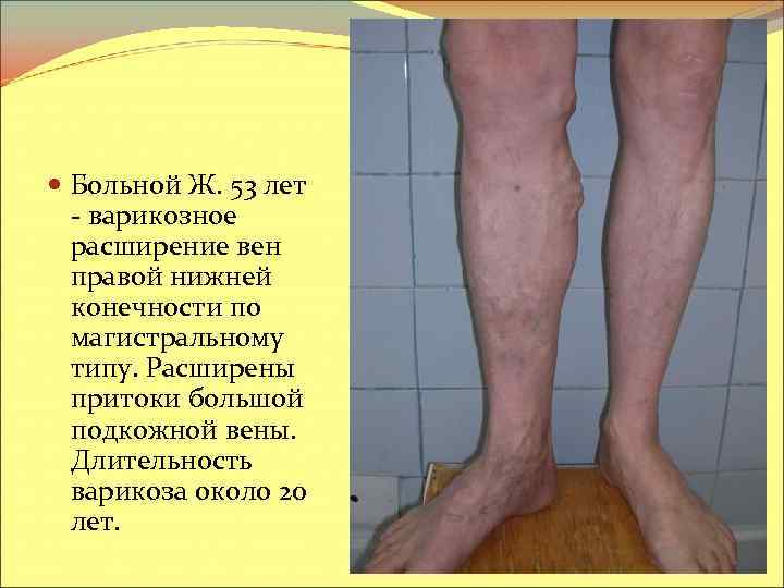  Больной Ж. 53 лет - варикозное расширение вен правой нижней конечности по магистральному
