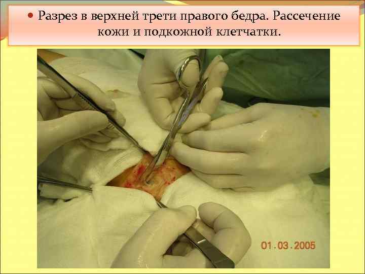  Разрез в верхней трети правого бедра. Рассечение кожи и подкожной клетчатки. 