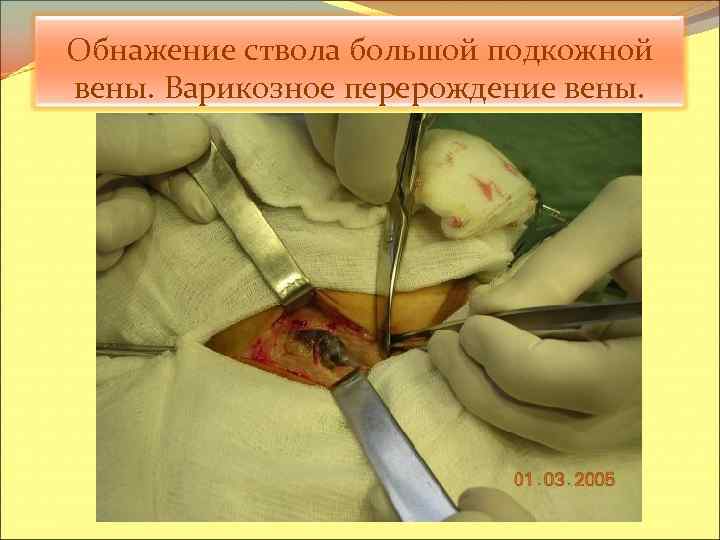 Обнажение ствола большой подкожной вены. Варикозное перерождение вены. 