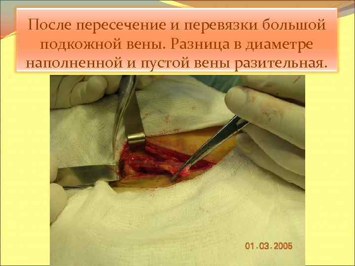 После пересечение и перевязки большой подкожной вены. Разница в диаметре наполненной и пустой вены