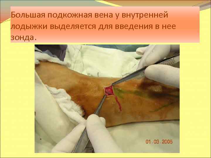 Большая подкожная вена у внутренней лодыжки выделяется для введения в нее зонда. 