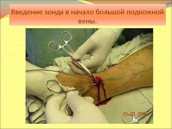 Введение зонда в начало большой подкожной вены. 