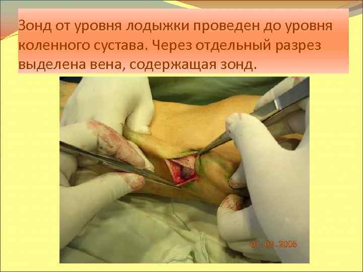 Зонд от уровня лодыжки проведен до уровня коленного сустава. Через отдельный разрез выделена вена,