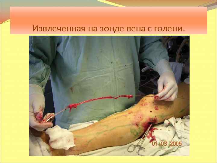 Извлеченная на зонде вена с голени. 