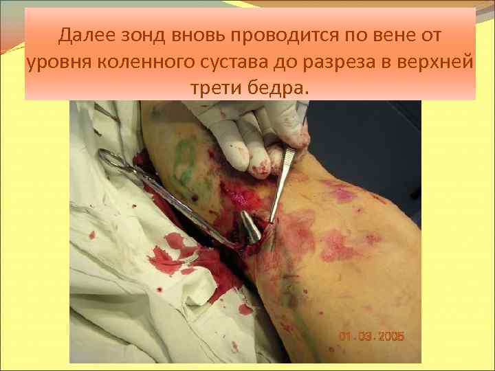 Далее зонд вновь проводится по вене от уровня коленного сустава до разреза в верхней