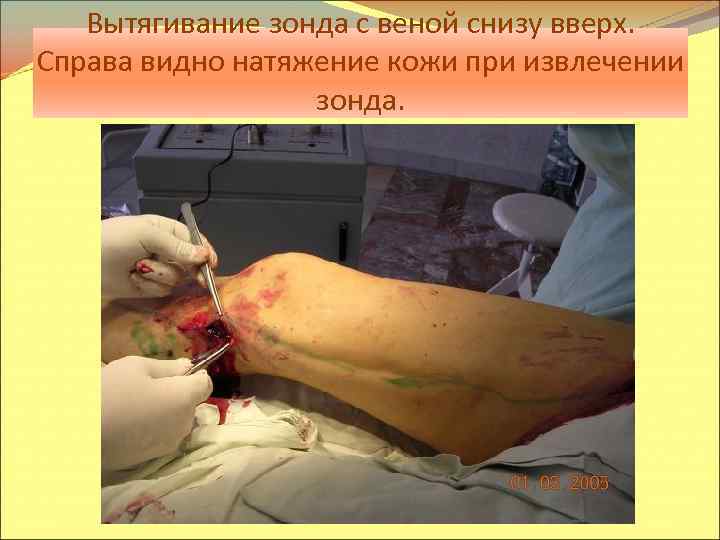 Вытягивание зонда с веной снизу вверх. Справа видно натяжение кожи при извлечении зонда. 