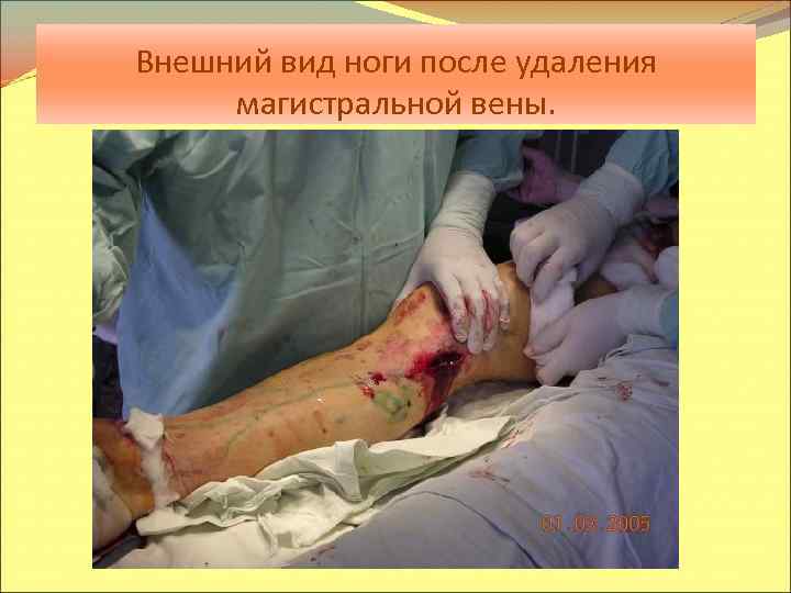 Внешний вид ноги после удаления магистральной вены. 