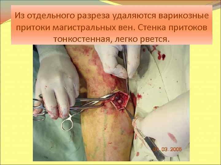Из отдельного разреза удаляются варикозные притоки магистральных вен. Стенка притоков тонкостенная, легко рвется. 