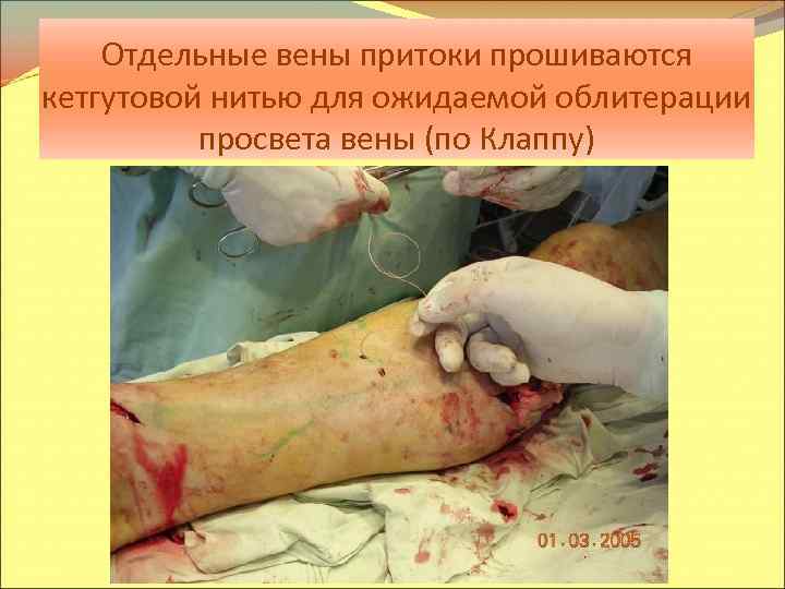 Отдельные вены притоки прошиваются кетгутовой нитью для ожидаемой облитерации просвета вены (по Клаппу) 