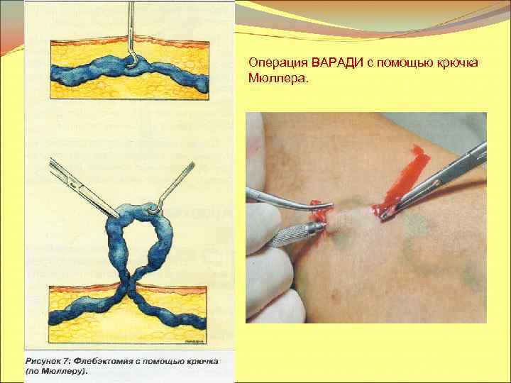 Операция ВАРАДИ с помощью крючка Мюллера. 