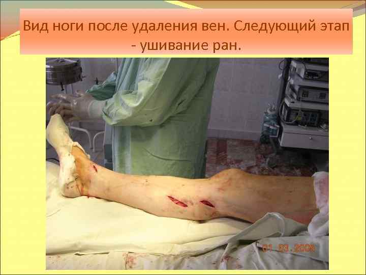 Вид ноги после удаления вен. Следующий этап - ушивание ран. 