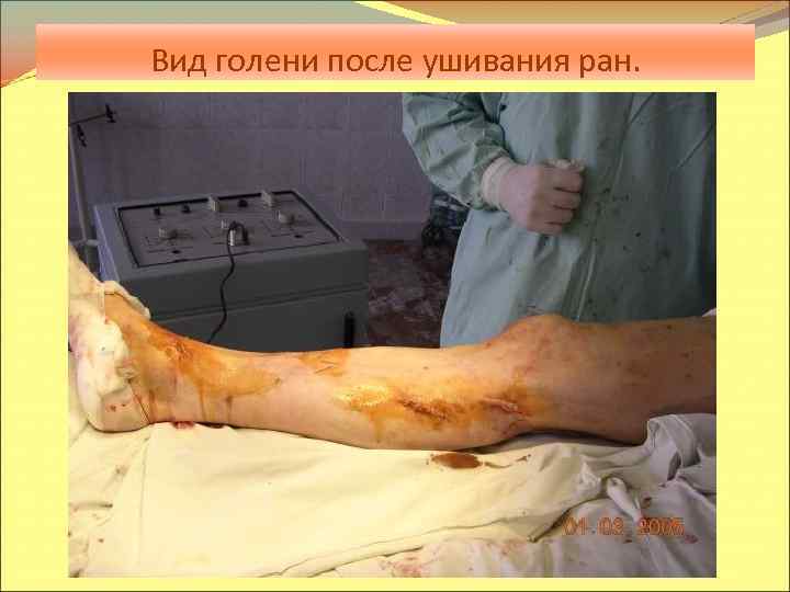 Вид голени после ушивания ран. 