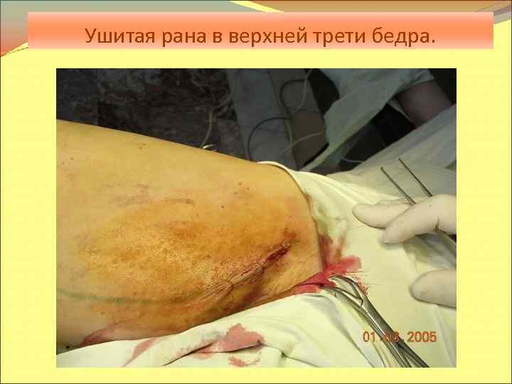 Ушитая рана в верхней трети бедра. 