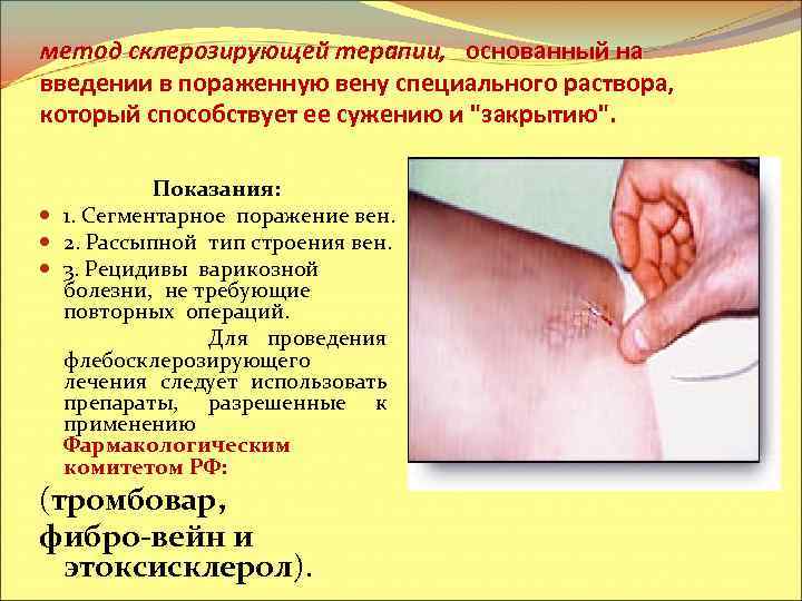 метод склерозирующей терапии, основанный на введении в пораженную вену специального раствора, который способствует ее