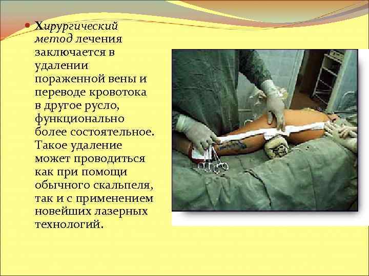  Хирургический метод лечения заключается в удалении пораженной вены и переводе кровотока в другое