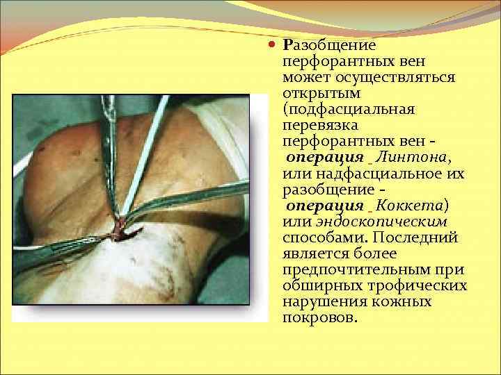  Разобщение перфорантных вен может осуществляться открытым (подфасциальная перевязка перфорантных вен - операция Линтона,