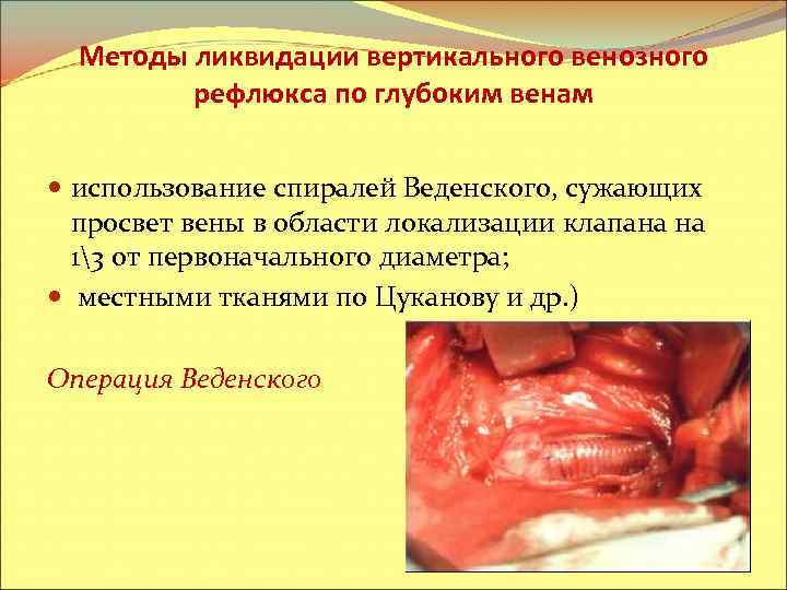 Методы ликвидации вертикального венозного рефлюкса по глубоким венам использование спиралей Веденского, сужающих просвет вены