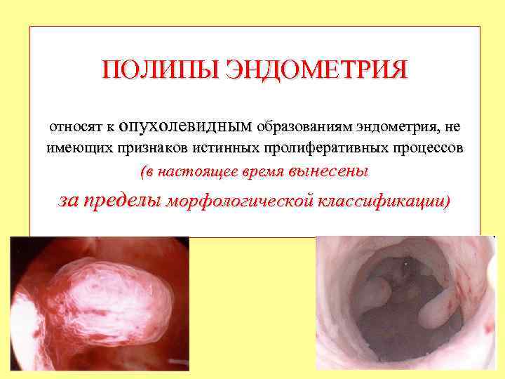 ПОЛИПЫ ЭНДОМЕТРИЯ относят к опухолевидным образованиям эндометрия, не имеющих признаков истинных пролиферативных процессов (в