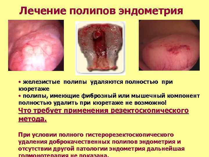 Лечение полипов эндометрия • железистые полипы удаляются полностью при кюретаже • полипы, имеющие фиброзный