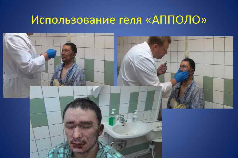 Использование геля «АППОЛО» 