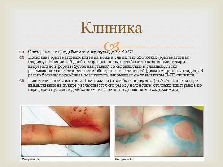 Клиника Острое начало с подъёмом температуры до 39– 40 °C Появление эритематозных пятен на