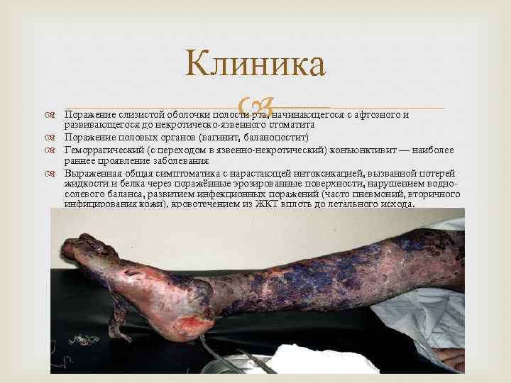 Клиника Поражение слизистой оболочки полости рта, начинающегося с афтозного и развивающегося до некротическо-язвенного стоматита