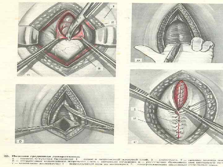 Истмико корпоральный разрез на матке рисунок