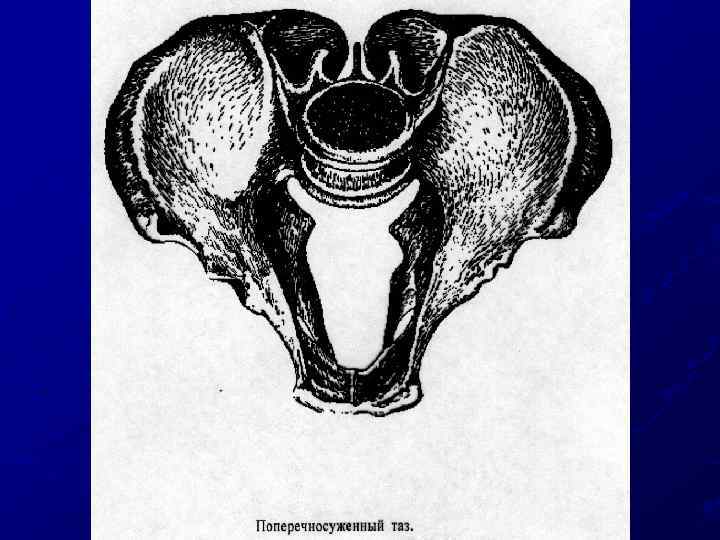 Какой таз лучше. Клинически узкий таз анатомия. Таз женщины. Поперечносуженный таз 1 степени. Поперечно суженный таз.