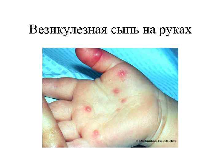 Везикулезная сыпь на руках 