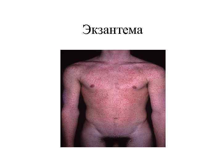 Экзантема 