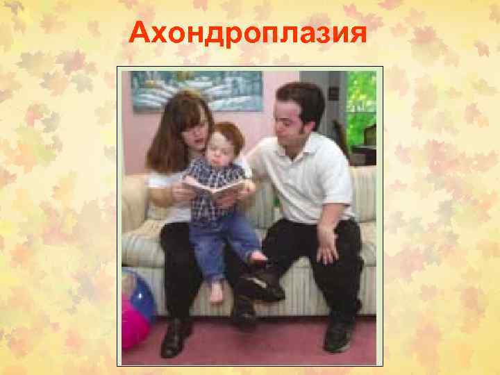 Ахондроплазия 