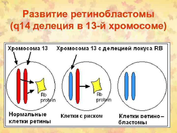 Развитие ретинобластомы (q 14 делеция в 13 -й хромосоме) 