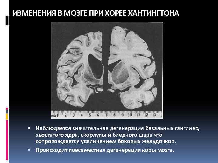 ИЗМЕНЕНИЯ В МОЗГЕ ПРИ ХОРЕЕ ХАНТИНГТОНА Наблюдается значительная дегенерация базальных ганглиев, хвостатого ядра, скорлупы