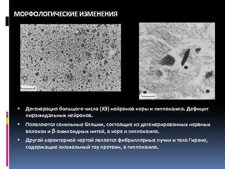 МОРФОЛОГИЧЕСКИЕ ИЗМЕНЕНИЯ Дегенерация большого числа (ХЭ) нейронов коры и гиппокампа. Дефицит пирамидальных нейронов. Появляются