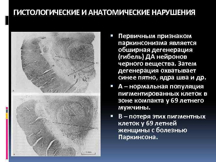 Дегенерация 3 степени