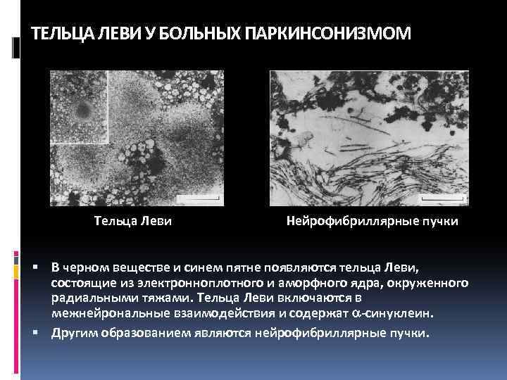 Деменции с тельцами. Тельца Леви. Тельца Леви при болезни Паркинсона. Болезнь Телец Леви. Болезнь диффузных Телец Леви.