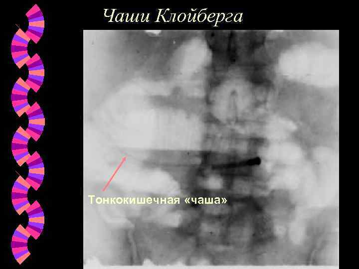 Чаши Клойберга Тонкокишечная «чаша» 