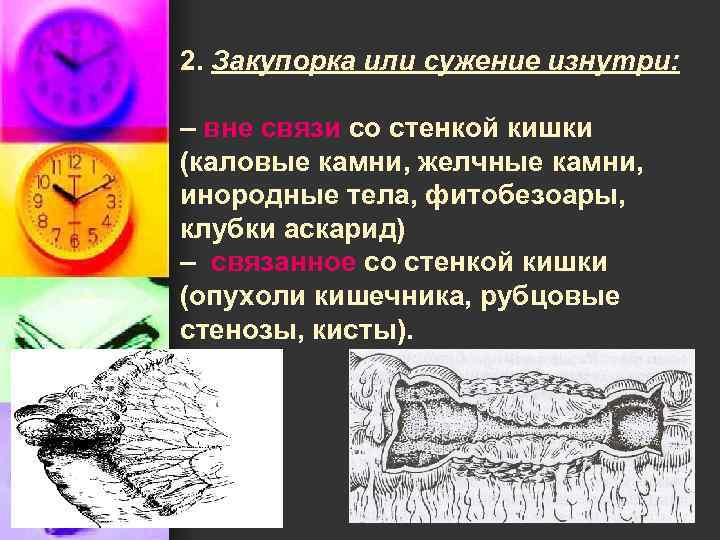 2. Закупорка или сужение изнутри: – вне связи со стенкой кишки (каловые камни, желчные