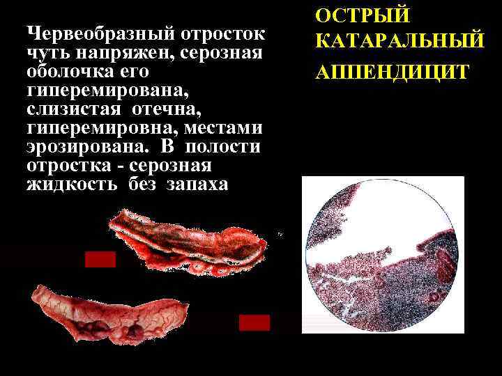Червеобразный отросток чуть напряжен, серозная оболочка его гиперемирована, слизистая отечна, гиперемировна, местами эрозирована. В