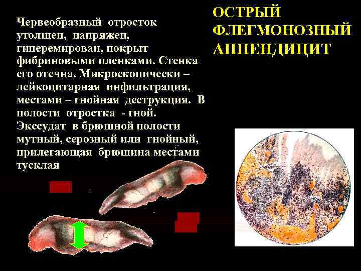Червеобразный отросток утолщен, напряжен, гиперемирован, покрыт фибриновыми пленками. Стенка его отечна. Микроскопически – лейкоцитарная