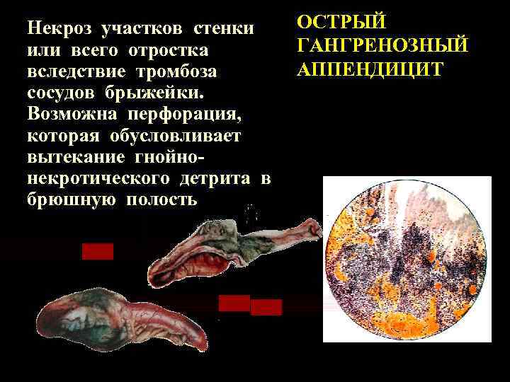 Некроз участков стенки или всего отростка вследствие тромбоза сосудов брыжейки. Возможна перфорация, которая обусловливает