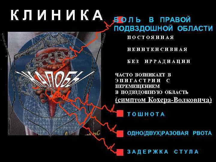 КЛИНИКА Б О Л Ь В ПРАВОЙ ПОДВЗДОШНОЙ ОБЛАСТИ ПОСТОЯННАЯ НЕИНТЕНСИВНАЯ БЕЗ ИРРАДИАЦИИ ЧАСТО